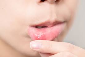 Afty w jamie ustnej i na języku u 8 letniego chłopca