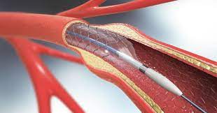 Ból w uchu i problemy kardiologiczne, operacja: 5 bajpasów