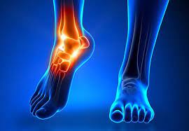 Skręcenie i złamanie w obrębie stawu skokowego bocznej kostki.